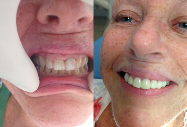 Before and after shots - the result of my dental tourism in Mexico. What a difference!